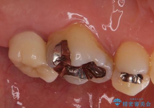 銀歯を白くしたいセラミック治療。の治療後