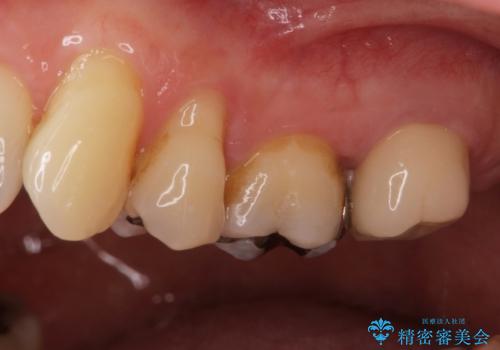銀歯を白くしたいセラミック治療。の治療後