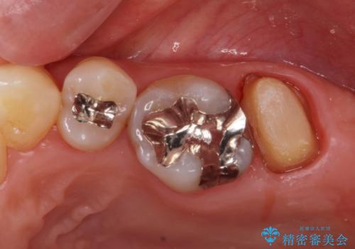 銀歯を白くしたいセラミック治療。の治療中