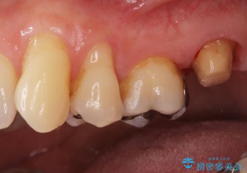 銀歯を白くしたいセラミック治療。の治療中
