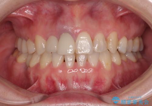 破折した前歯のインプラント 1DAYインプラントで短期間治療の治療前