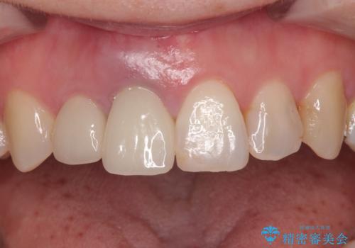 破折した前歯のインプラント 1DAYインプラントで短期間治療の症例 治療前