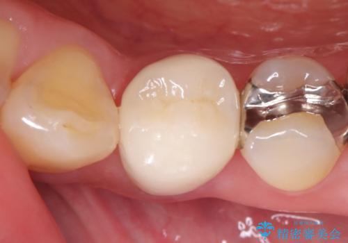 銀歯の下に虫歯 〈オールセラミッククラウン〉の治療後
