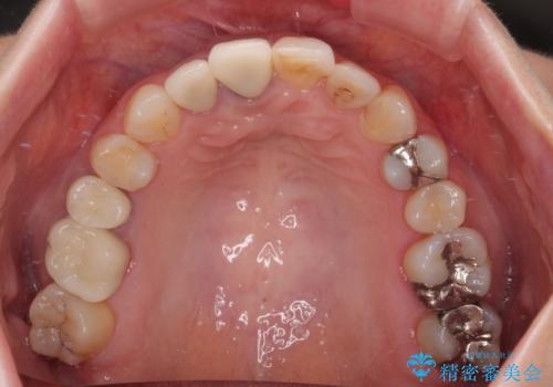 破折した前歯のインプラント 1DAYインプラントで短期間治療の治療前