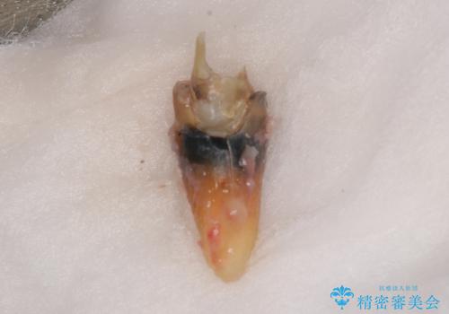 破折した前歯のインプラント 1DAYインプラントで短期間治療の治療中