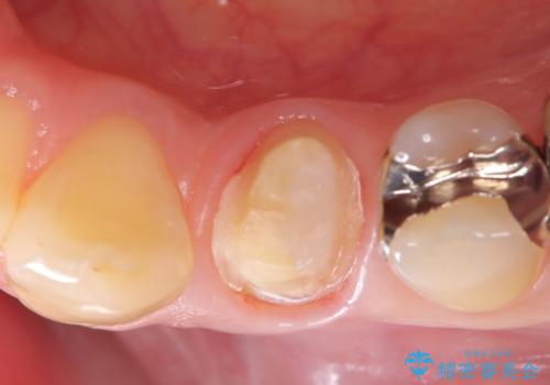 銀歯の下に虫歯 〈オールセラミッククラウン〉の治療中