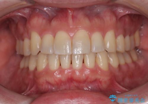 インビザラインは煩わしい ワイヤー矯正で短期間矯正治療の症例 治療後
