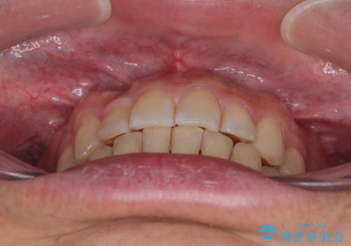 インビザラインは煩わしい ワイヤー矯正で短期間矯正治療の治療後