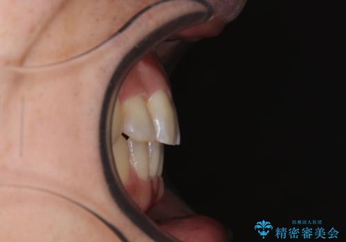 インビザラインは煩わしい ワイヤー矯正で短期間矯正治療の治療後