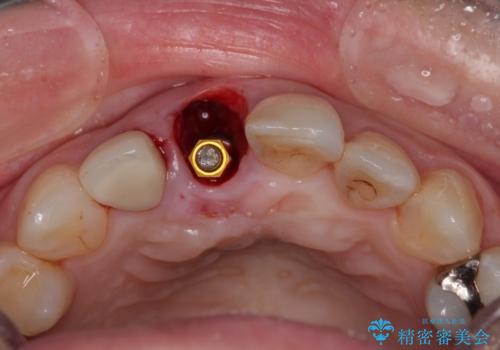 破折した前歯のインプラント 1DAYインプラントで短期間治療の治療中