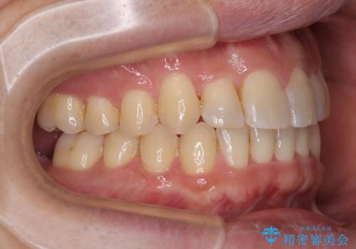 インビザラインは煩わしい ワイヤー矯正で短期間矯正治療の治療後
