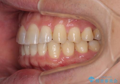 インビザラインは煩わしい ワイヤー矯正で短期間矯正治療の治療後