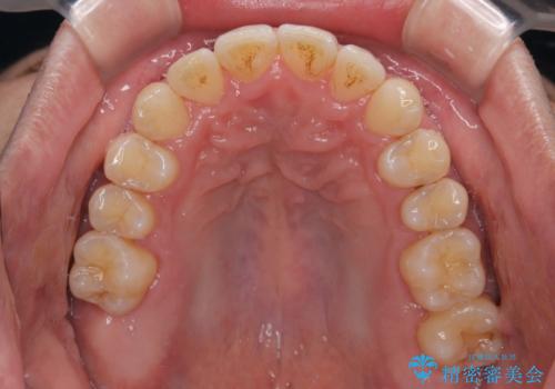 インビザラインは煩わしい ワイヤー矯正で短期間矯正治療の治療後
