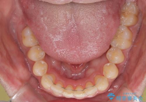 インビザラインは煩わしい ワイヤー矯正で短期間矯正治療の治療後