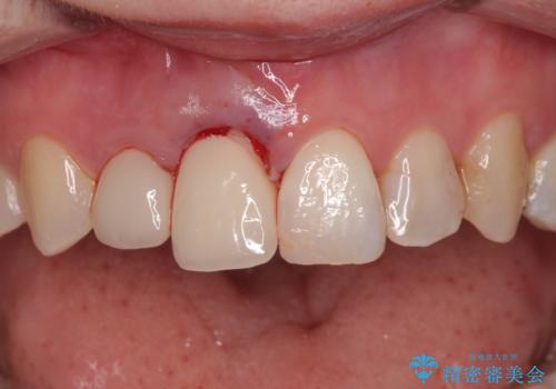 破折した前歯のインプラント 1DAYインプラントで短期間治療の治療中