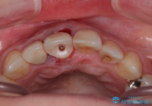 破折した前歯のインプラント 1DAYインプラントで短期間治療の治療中