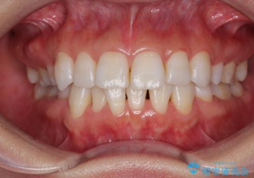 矯正治療の後戻り インビザラインで短期間矯正治療の治療前