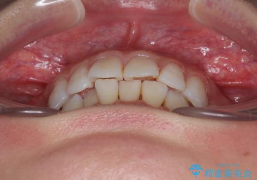 矯正治療の後戻り インビザラインで短期間矯正治療の治療前