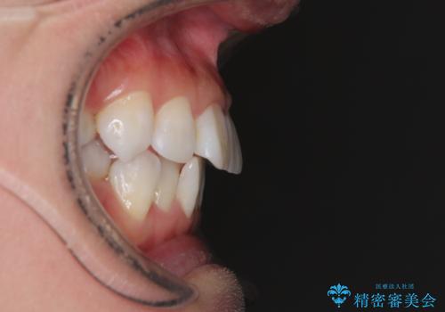 矯正治療の後戻り インビザラインで短期間矯正治療の治療前
