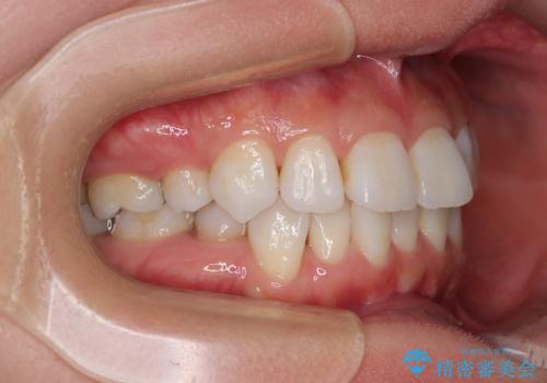 矯正治療の後戻り インビザラインで短期間矯正治療の治療前
