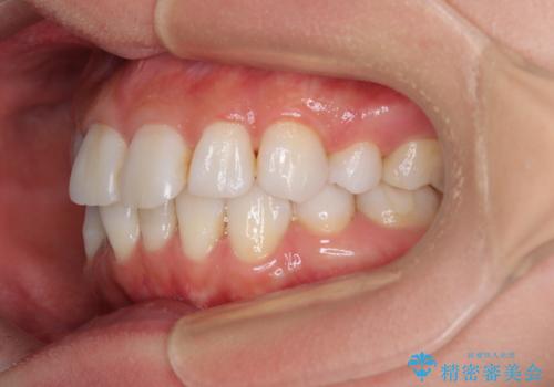 矯正治療の後戻り インビザラインで短期間矯正治療の治療前