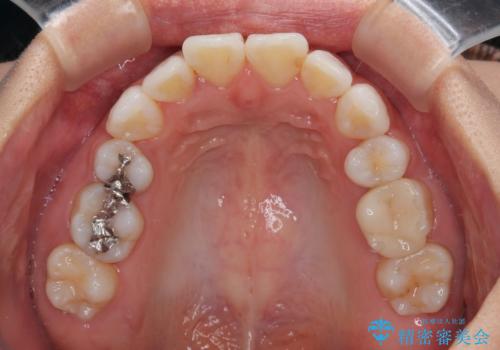 矯正治療の後戻り インビザラインで短期間矯正治療の治療前