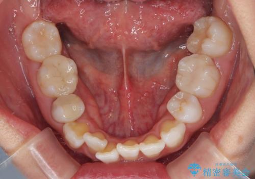 矯正治療の後戻り インビザラインで短期間矯正治療の治療前