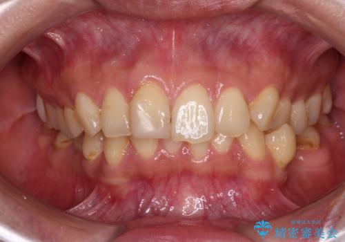 デコボコと乳歯の欠損 ワイヤー矯正とインプラント補綴治療の症例 治療前