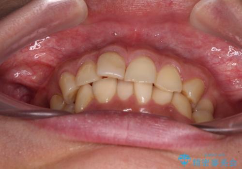 デコボコと乳歯の欠損 ワイヤー矯正とインプラント補綴治療の治療前