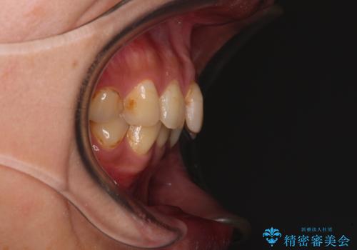 デコボコと乳歯の欠損 ワイヤー矯正とインプラント補綴治療の治療前