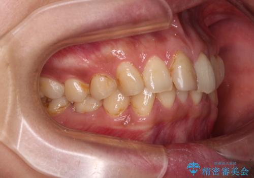 デコボコと乳歯の欠損 ワイヤー矯正とインプラント補綴治療の治療前