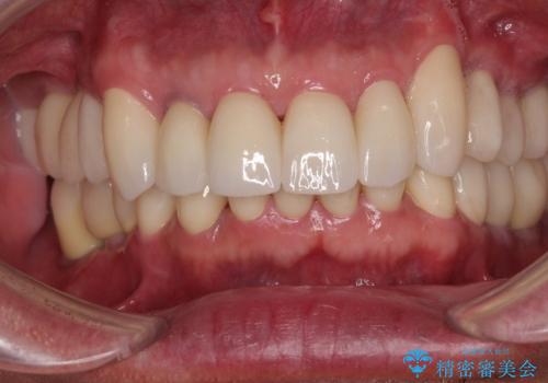 強い咬合力で奥歯がボロボロに インプラント治療による咬合回復と全顎セラミック治療の症例 治療後