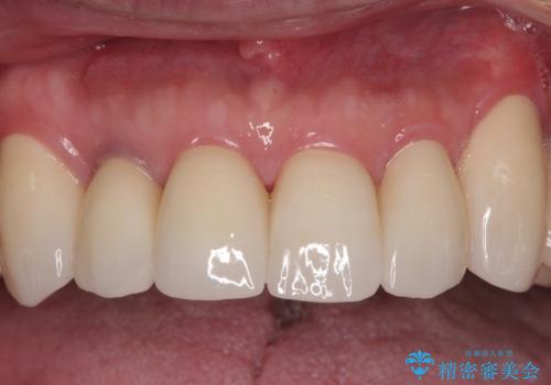 強い咬合力で奥歯がボロボロに インプラント治療による咬合回復と全顎セラミック治療の治療後