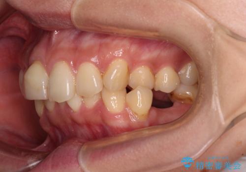 デコボコと乳歯の欠損 ワイヤー矯正とインプラント補綴治療の治療前