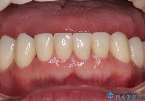 強い咬合力で奥歯がボロボロに インプラント治療による咬合回復と全顎セラミック治療の治療後