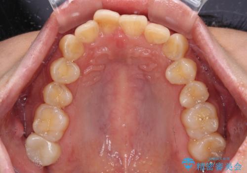 デコボコと乳歯の欠損 ワイヤー矯正とインプラント補綴治療の治療前