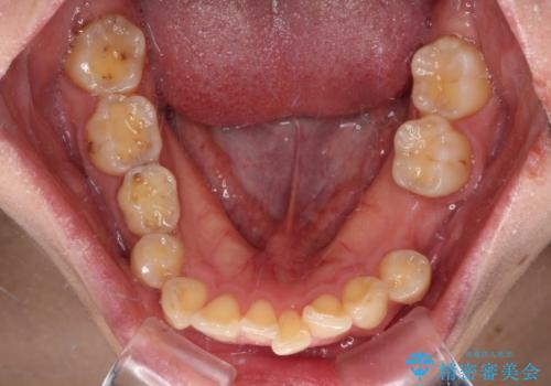 デコボコと乳歯の欠損 ワイヤー矯正とインプラント補綴治療の治療前