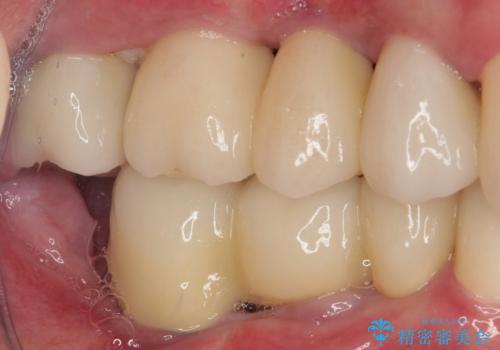強い咬合力で奥歯がボロボロに インプラント治療による咬合回復と全顎セラミック治療の治療後