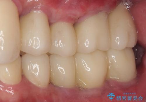 強い咬合力で奥歯がボロボロに インプラント治療による咬合回復と全顎セラミック治療の治療後