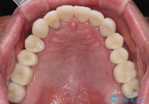 強い咬合力で奥歯がボロボロに インプラント治療による咬合回復と全顎セラミック治療の治療後