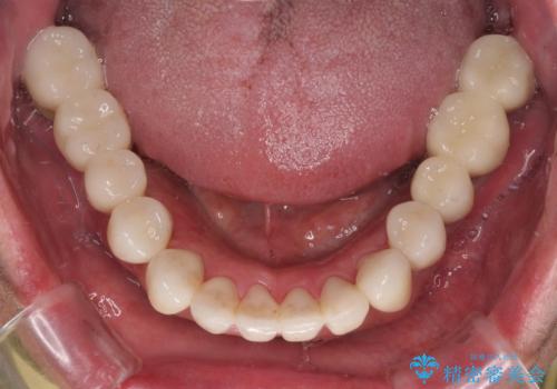 強い咬合力で奥歯がボロボロに インプラント治療による咬合回復と全顎セラミック治療の治療後