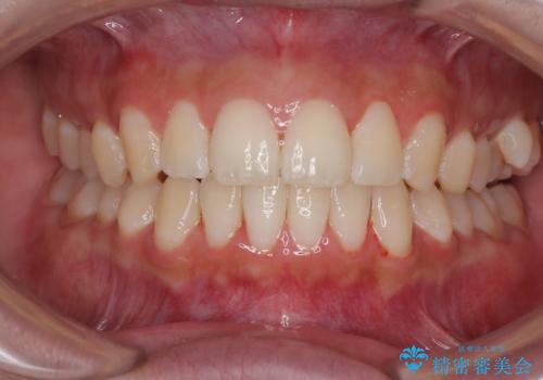 目立たないマウスピース矯正で下の前歯のデコボコをスッキリ解消!たった1年で整った歯並びにの症例 治療後