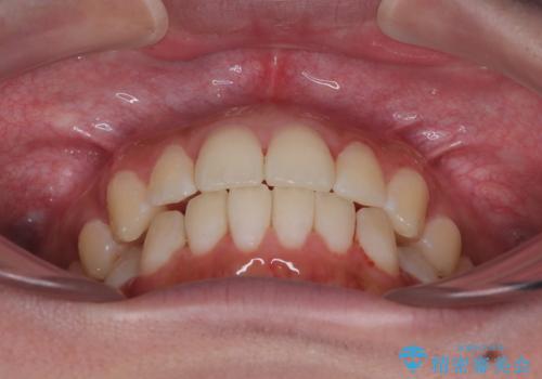 目立たないマウスピース矯正で下の前歯のデコボコをスッキリ解消!たった1年で整った歯並びにの治療後