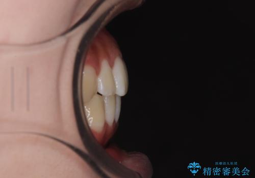 目立たないマウスピース矯正で下の前歯のデコボコをスッキリ解消!たった1年で整った歯並びにの治療後