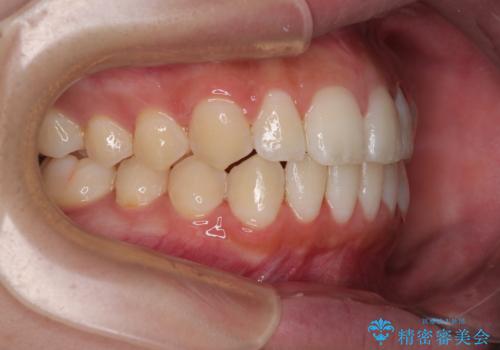 目立たないマウスピース矯正で下の前歯のデコボコをスッキリ解消!たった1年で整った歯並びにの治療後