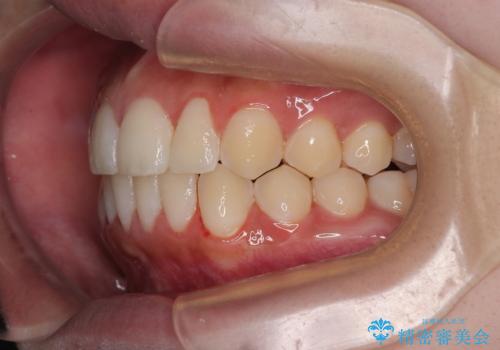 目立たないマウスピース矯正で下の前歯のデコボコをスッキリ解消!たった1年で整った歯並びにの治療後