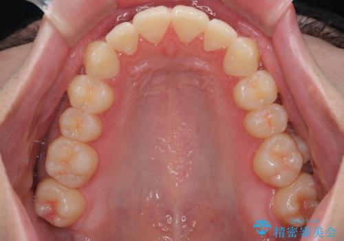 目立たないマウスピース矯正で下の前歯のデコボコをスッキリ解消!たった1年で整った歯並びにの治療後