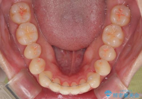 目立たないマウスピース矯正で下の前歯のデコボコをスッキリ解消!たった1年で整った歯並びにの治療後