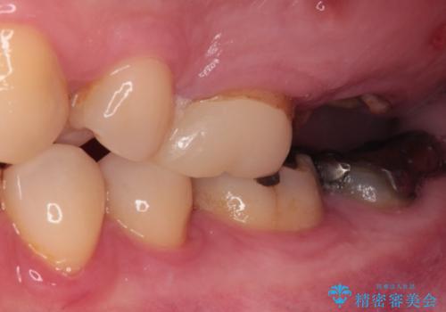 奥歯のむし歯が気になる 根管治療とインプラント治療の治療前
