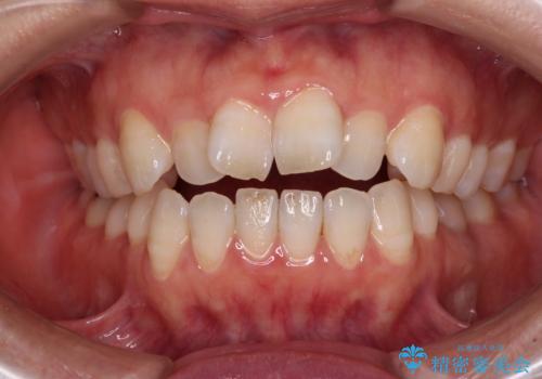 【モニター】飛び出した上顎前歯 補助装置を併用したインビザライン矯正治療の症例 治療前